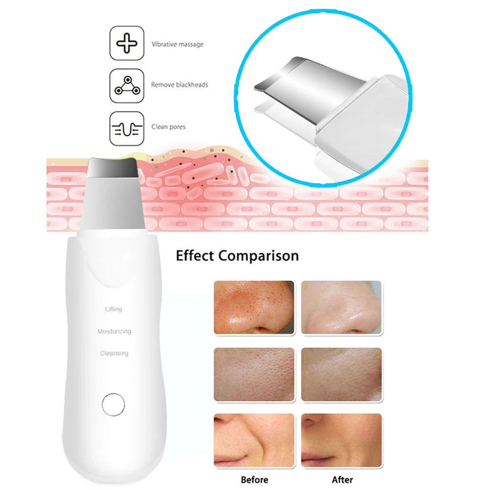 Facial Ultrassônico Scrubber com Vibração Profunda, Limpador Facial, Espátula para Remoção de Cravos, Massageador Facial